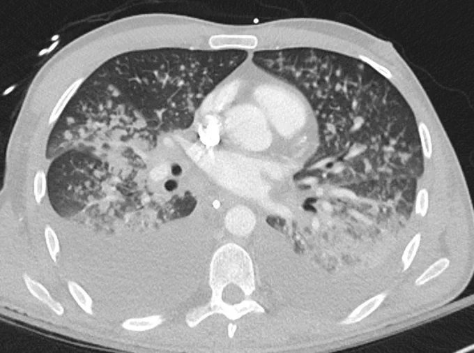 Chest CT shows extensive bilateral pulmonary nodules and nodular consolidation with diffuse ground-glass opacity. Additionally, bilateral pleural effusions and hilar lymphadenopathy are present.