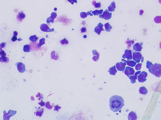 MGG stained smear