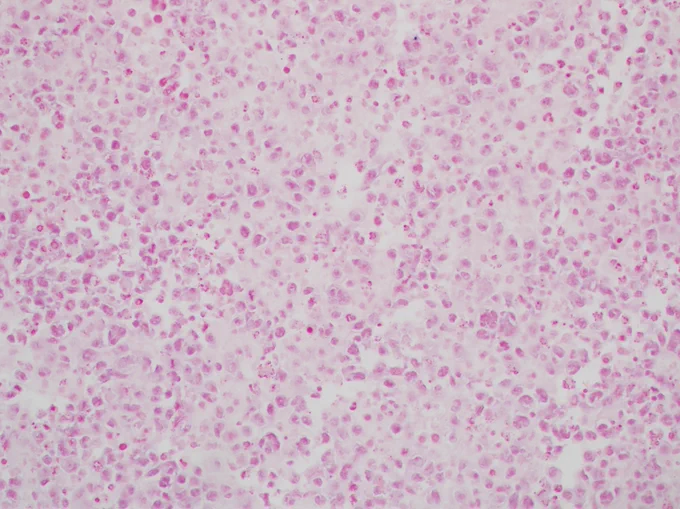 EBV by in situ hybridization (EBER)