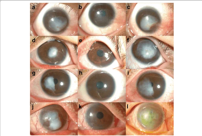 Image 3: Various corneal keloid sizes in four patients.