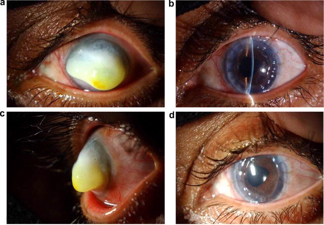 Image 4: The clinical appearance of a corneal keloid compared to the eye six months after surgery.