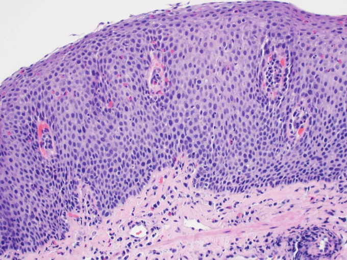 Extreme basal cell hyperplasia