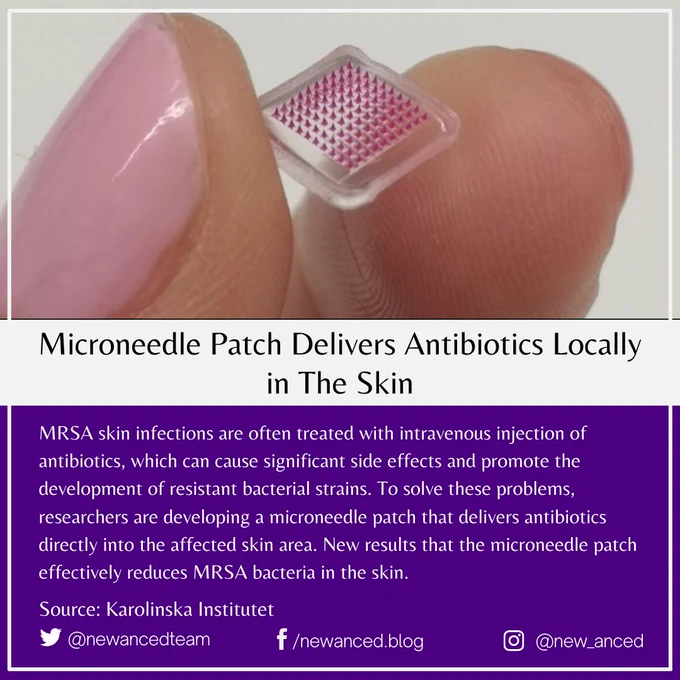 MRSA skin infections are often treated with intravenous injection of antibiotics, which can cause significant side effects and promote the development of resistant bacterial strains. To solve these problems, researchers are developing a microneedle patch that delivers antibiotics directly into the affected skin area. New results that the microneedle patch effectively reduces MRSA bacteria in the skin.