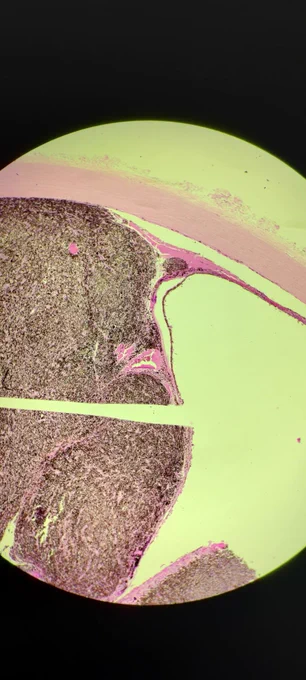 Pigmented Melanoma