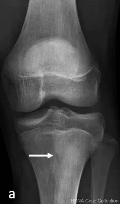 Anteroposterior radiograph of the left knee demonstrates subtle, ill-defined sclerosis in the left proximal tibial metadiaphysis (arrow).