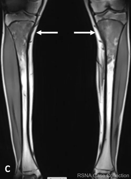 Coronal T1-weighted image of the bilateral tibias demonstrate symmetrical T1 hypointensity involving the bilateral, proximal tibial metadiaphyses.