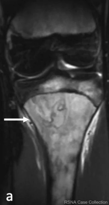 Coronal STIR image of the left knee demonstrates confluent hyperintense intramedullary signal involving the left proximal tibial metadiaphysis and tibial epiphysis. There is a serpiginous area in the medullary bone of the left medial tibial metaphysis (arrow) which may represent a bone infarct.