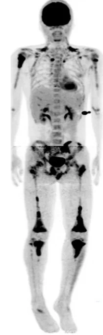 Maximum intensity projection (MIP) image from a whole-body PET/CT demonstrates extensive multifocal hypermetabolic intramedullary lesions in the appendicular greater than axial skeleton.