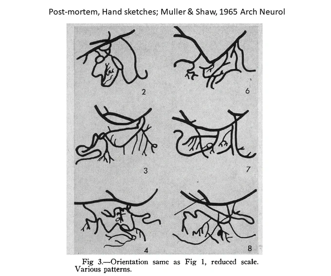 Figure 3 from Muller & Shaw (1965) Archives of Neurology, displaying 6 variations of extrahippocampal arterial arcades. Captioned "post-mortem, hand sketches".
