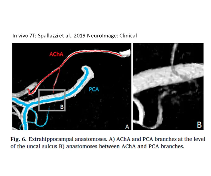 Figure 6 from Spallazzi et al. (2019) NeuroImage: Clinical, displaying a MRI of extrahippocampal arterial arcade. Captioned "In vivo 7T".
