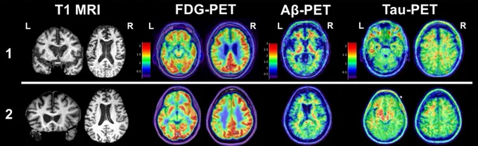 Representative slices of antemortem structural T1 magnetic resonance imaging (T1 MRI), FDG-PET, Aβ-PET (PIB), and tau-PET (FTP) for 2 clinically impaired adults with prior repetitive head trauma meeting criteria for “Probable CTE” (see text for case descriptions).