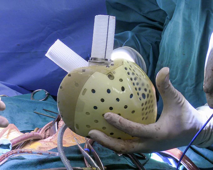 CARMAT device implanted by @DukeHeartCenter surgeons at Duke University Hospital
