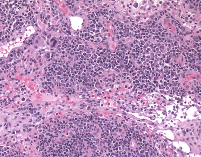 Plasma cell rich area