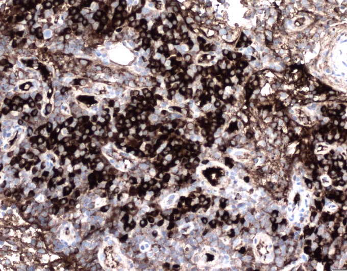 Kappa immunostain in plasma cell rich area
