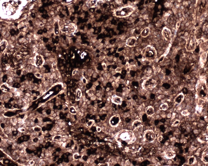 Lambda immunostain in plasma cell rich area