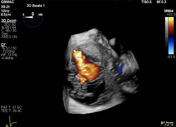 Baseline 3D color of severe-massive TR