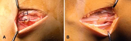 Figure 3. (A) Reinforcement of attachment of strip of ITB to the Gerdy tubercle with interrupted absorbable sutures. (B) ITB defect is usually left open. ITB, iliotibial band.