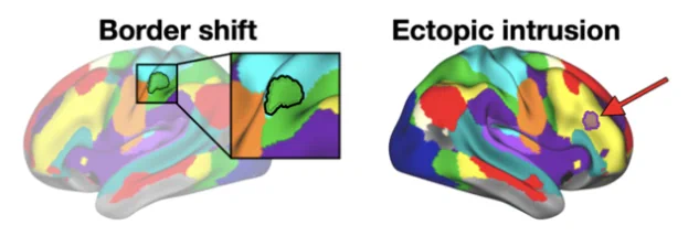 border shifts appear adjacent to their typical network location, while ectopic intrusions appear as isolated islands at a distance from their typical location