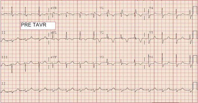 Pre TAVR EKG - 1st degree block, RBBB, LAFB. 