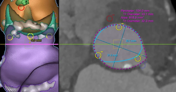 Large LVOT