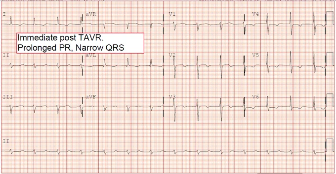 Immediate Post TAVR, prolonged PR, QRS narrowing. 