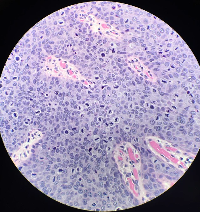 How many mitoses do you see in this 40x field?! 