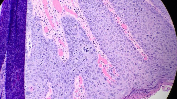 Low power, atypical mitoses