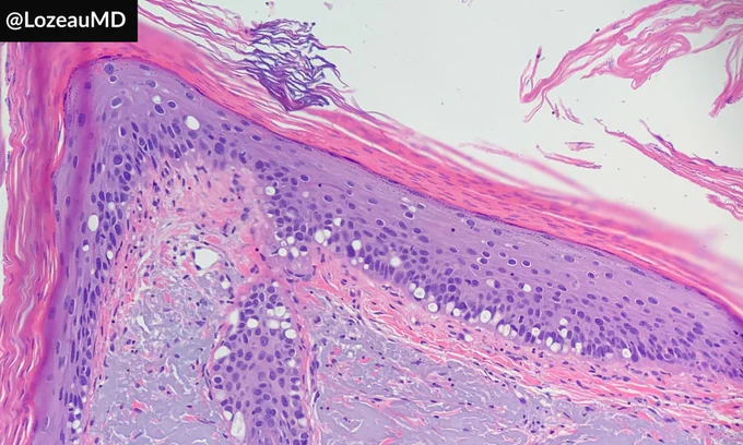 A skin biopsy with crowding of the basal layer of the epidermis, associated with parakeratosis and solar elastosis. Some of the keratinocytes are vacuolated giving them a clear cell or signet ring appearance.