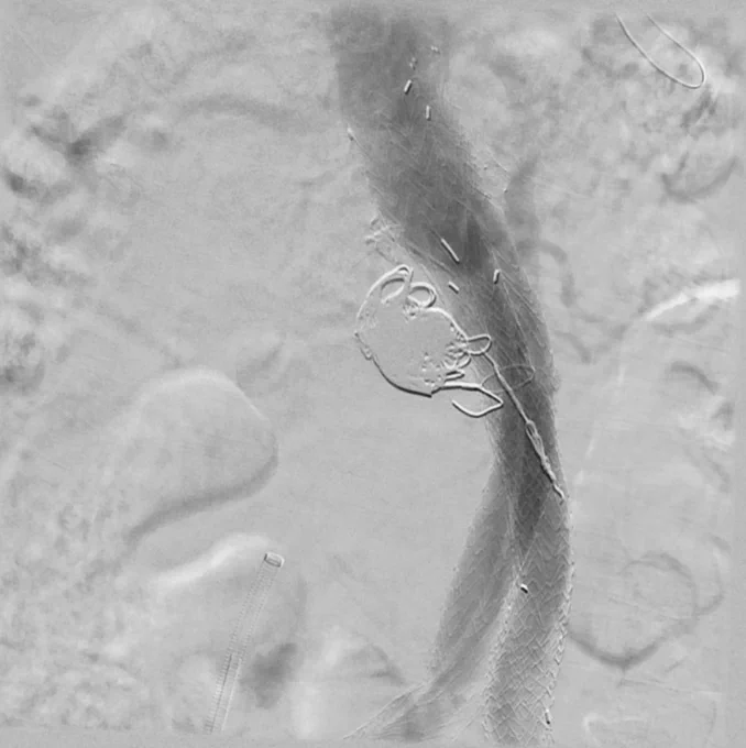 Post intervention aortogram without excluded sac opacification