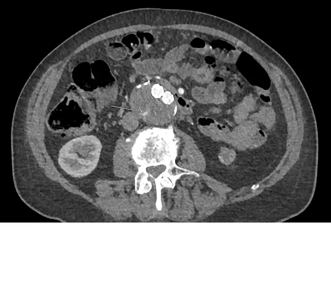 Type II Endoleak via L3-4 lumbar arterial branch shown with arrow