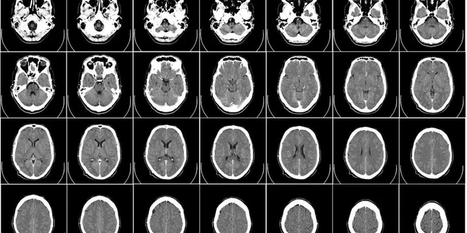 Brain scan