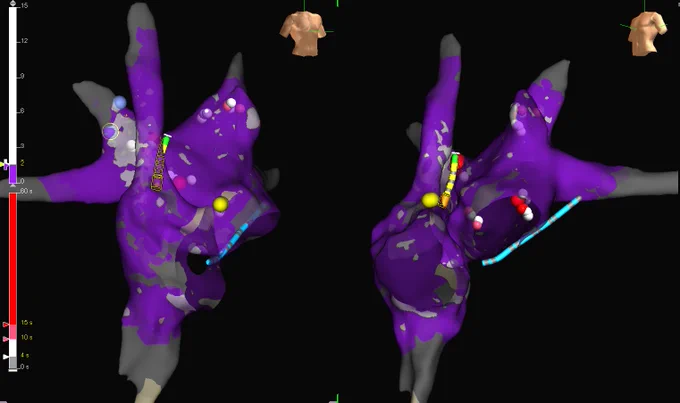 3D Fractionation map and final lesion set of Cardioneural Ablation