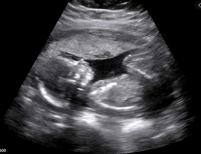 An ultrasound photo of a baby in utero