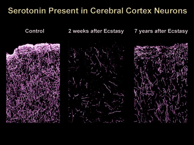 Source for image is a 20 YO paper that's heavily debunked: Long-Term Neuropsychiatric Consequences of
“Ecstasy” (MDMA): A Review by these people Alonso G. Montoya, MD, Renée Sorrentino, MD, Scott E. Lukas, PhD, and Bruce H. Price, MD. Here is one of the many paper shredding this rubbish to bits: https://onlinelibrary.wiley.com/doi/abs/10.1111/j.1360-0443.2006.01511.x As a governmental agency you MUST do your best to provide objective factual information. This is pure propaganda and stigmatizing. 