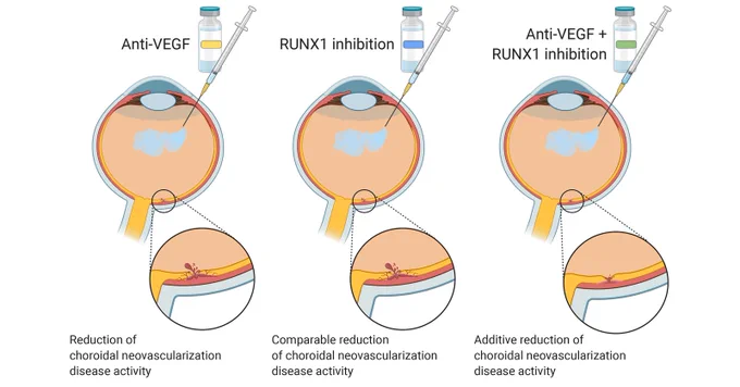 Illustration of RUNX1 inhibition combined with anti–vascular endothelial growth factor (anti-VEGF) therapy, which achieves better control of experimental choroidal neovascularization activity compared to monotherapy (Credit: The American Journal of Pathology).