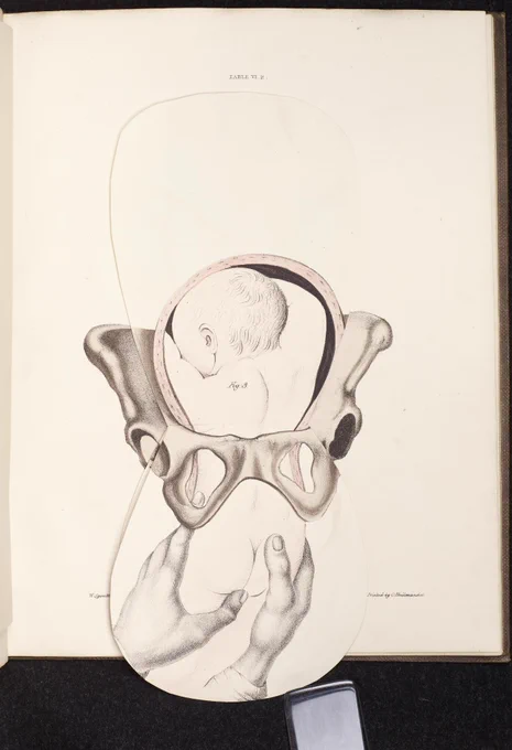 Illustration of baby being removed from pelvis