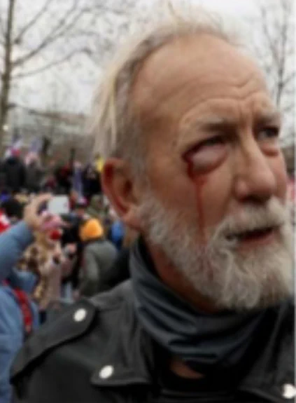 Capitol rioter 290 with a bruised eye and bleeding. 