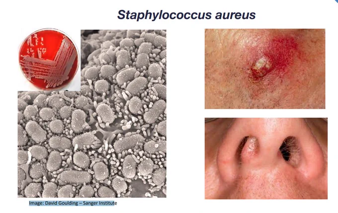 An composite image of the bacterium Staphylococcus  Aureus: electro microscope image, agar plate images, image of a skin infection, and image of a nasal activity.