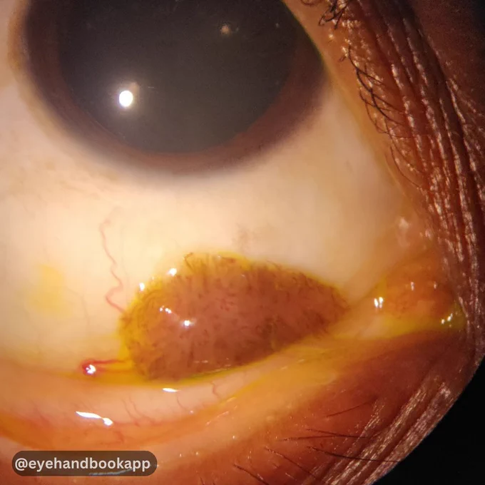 History: 25-year-old with a pigmented lesion in the lower fornix.

Make your job as an eye care professional easier with the #free Eye Handbook mobile app! Access calculators, forums, references, and information in seconds, right from your smartphone or tablet.

Available on Android & iOS:
https://onelink.to/eyehandbookapp