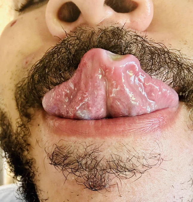 My tongue after surgery with a chunk missing