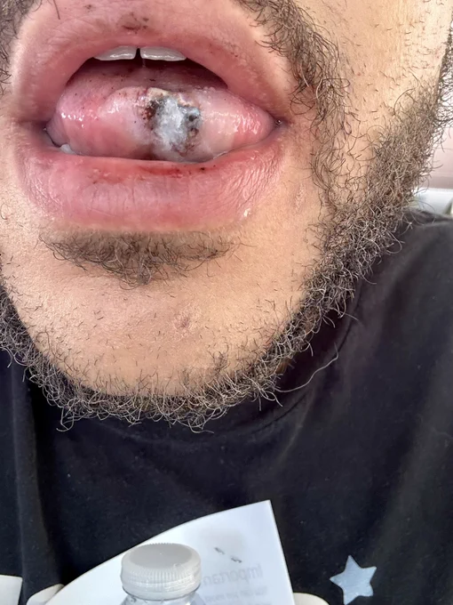 My tongue before surgery swollen and bloody.
