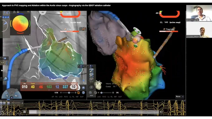 Successful ablation of a complex aortic cusp PVC.  Mapped using the Octaray.  Ablation attempted first from the trans-septal approach, then via the retrograde aortic approach, with success eventually from the great cardiac vein.  In this webinar, Professor Heeger shares his approach to visualising the coronary sinus cusp and proximity to the coronary arteries through the ablation catheter itself.  Extended discussion of this approach at the end.