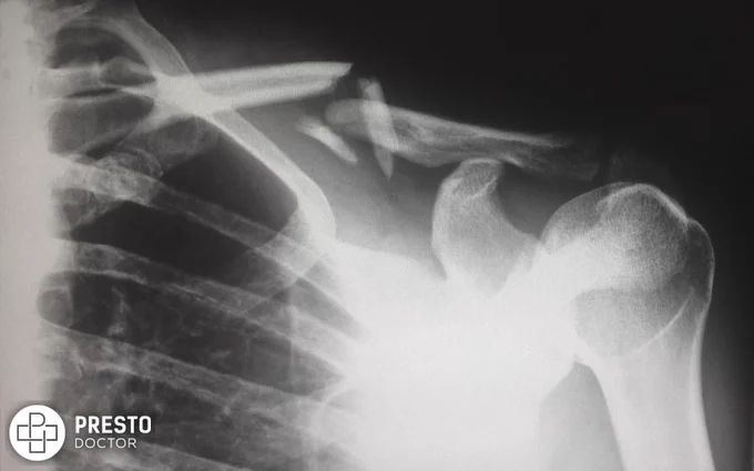 human X-ray result chart, Can Cannabinoids Promote Bone Regeneration?