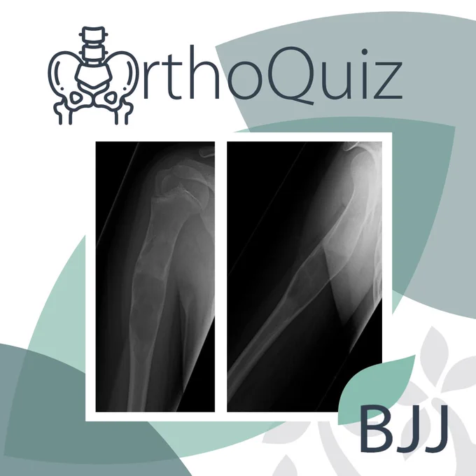 The Bone & Joint Journal OrthoQuiz. Radiographs of a shoulder injury.