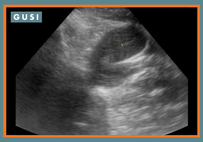 📑In this Case Study, a 38-year-old woman presents for follow-up 6 weeks after routine placement of a copper IUD. She reports some intermittent spotting and mild pelvic discomfort over the past month.

Exam demonstrates the IUD string extending 4 cm from cervical os (2 cm length documented on insertion). The IUD was removed and re-placement of the displaced IUD was recommended. However, the patient expresses concern about the discomfort and inconvenience of another follow-up pelvic exam, and the risk of having this happen again.  She worries that an IUD may not be her best choice for contraception. 

Review her POCUS exam results and read more on Case Study#1 👉https://globalultrasoundinstitute.com/improving-iud-insertion-care-with-pocus/

#pocus #Ultrasound #MedicalEducation #MedEd #pocusEducation #askpocus #UltrasoundTraining #pocusTraining #iud
