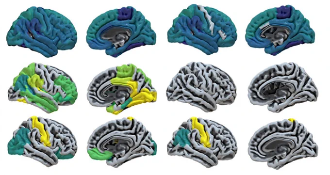 Glucose metabolism for healthy control subjects (top row), patients with a disorder of consciousness (middle row) and recovered patients (bottom row). Adapted from Annen et al. 2023.