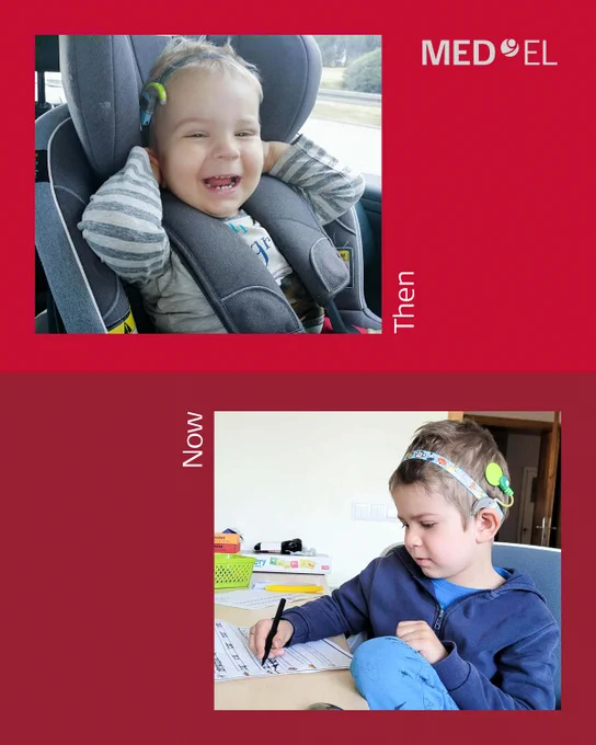Then vs. Now: 

In 2019, Boris received his first #cochlearimplant (CI).

 It's 2023 and look at him now! He's reading, writing, and rocking his bilateral #audioprocessors. 