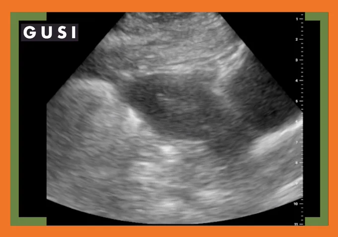 A 26-year-old G2P2 patient presents to discuss contraception.  She likes the convenience and reliability of an IUD, but is apprehensive because her sister told her that having her IUD placed was horribly painful.

You discuss the literature surrounding IUD insertion discomfort and decide to proceed with IUD insertion under ultrasound guidance based on its proven success in reducing pain during this procedure.

POCUS reveals a mid- position relatively straight uterus. Her cervical os is slightly patulous after 2 previous vaginal deliveries, so you elect to proceed with IUD insertion by the Uterine Sound Sparing Approach (UUSA)—which can also decrease pain with insertion.

