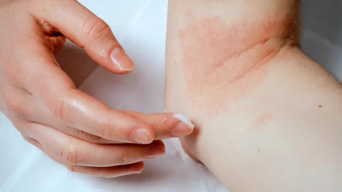 Person applying lotion to red skin