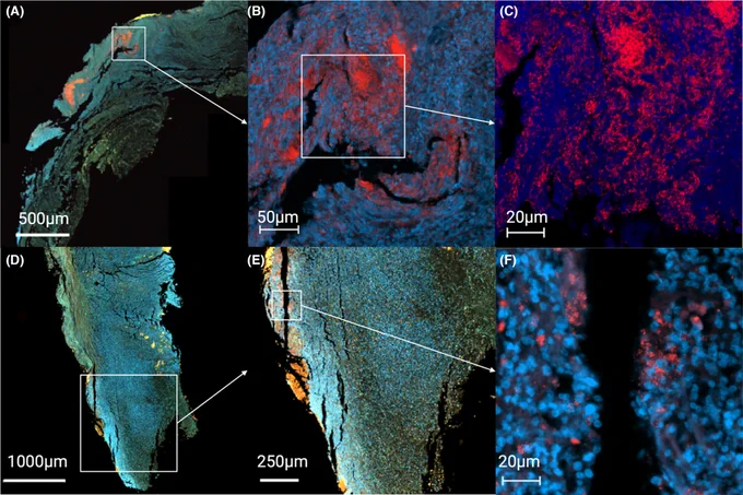Fig. 1. Progressive zoom‐in on large biofilms of Pseudomonas aeruginosa (A–C; patient 13) and Staphylococcus aureus (D–F; Patient 9) found in tissue from patients with chronic leg wounds. P. aeruginosa and S. aureus were stained by species‐specific PNA‐FISH probes, and images were acquired with a slide scanner (A–B, D–E) or by a confocal laser scanning microscope (C, F).